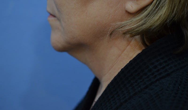 FaceTite Before and After Before & After Gallery - Patient 210684 - Image 1