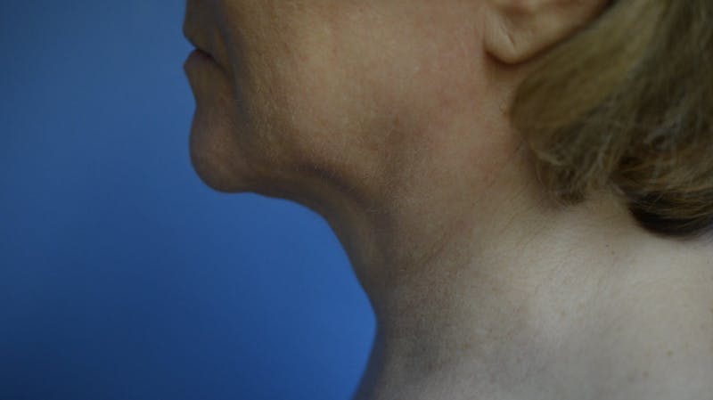 FaceTite Before and After Before & After Gallery - Patient 210684 - Image 2