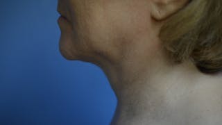 FaceTite Before and After Before & After Gallery - Patient 210684 - Image 2