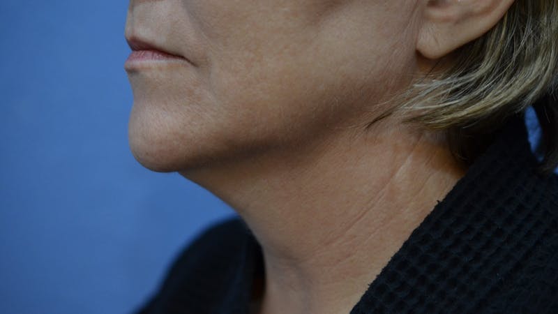 FaceTite Before and After Before & After Gallery - Patient 210684 - Image 3