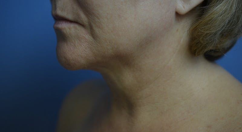 FaceTite Before and After Before & After Gallery - Patient 210684 - Image 4