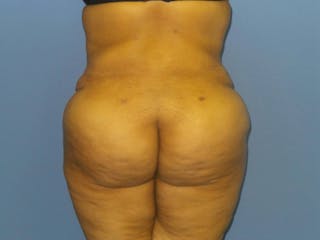 BodyTite™ Before and After Before & After Gallery - Patient 484684 - Image 4
