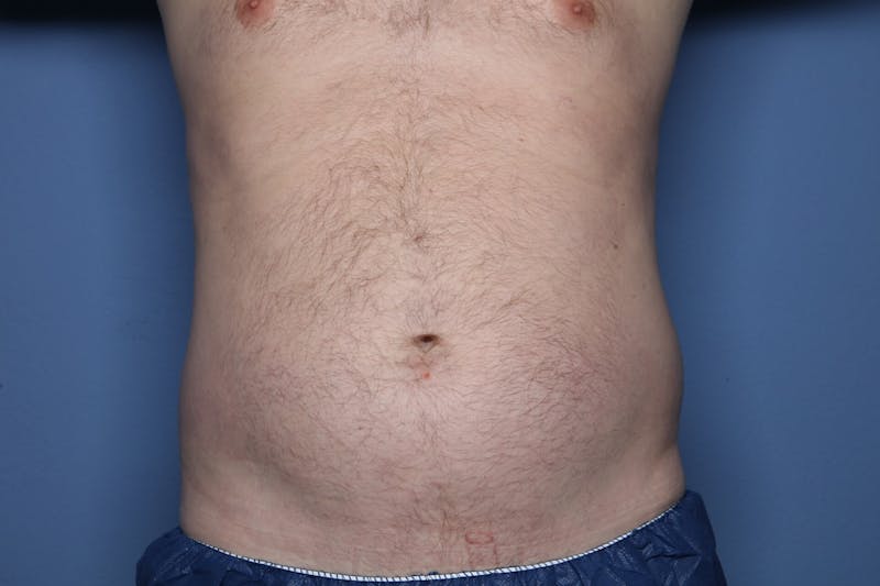 Liposuction Before & After Gallery - Patient 363436 - Image 1