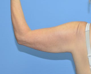 BodyTite™ Before and After Before & After Gallery - Patient 258931 - Image 4