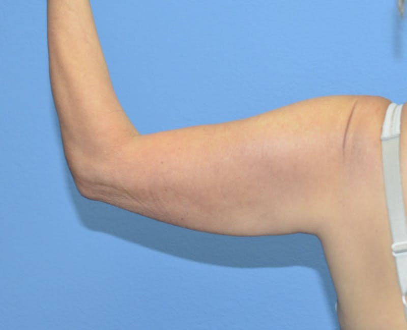 BodyTite™ Before and After Before & After Gallery - Patient 258931 - Image 4