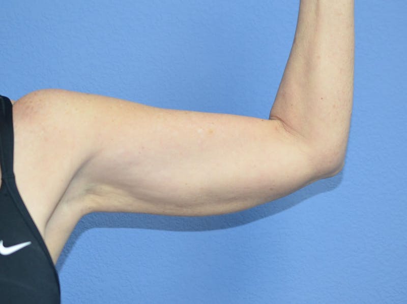 BodyTite™ Before and After Before & After Gallery - Patient 110220 - Image 2