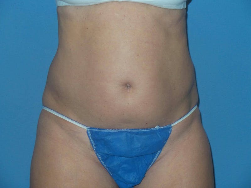 BodyTite™ Before and After Before & After Gallery - Patient 103921 - Image 1