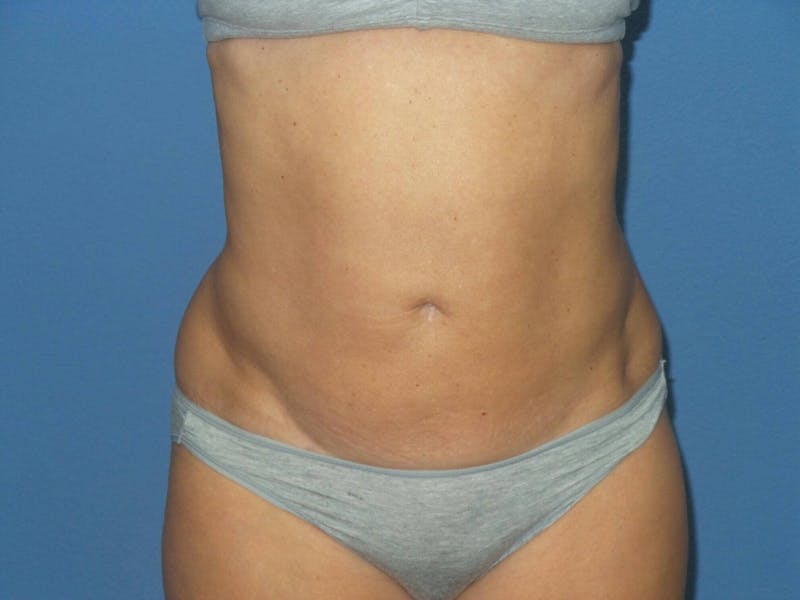 BodyTite™ Before and After Before & After Gallery - Patient 103921 - Image 2