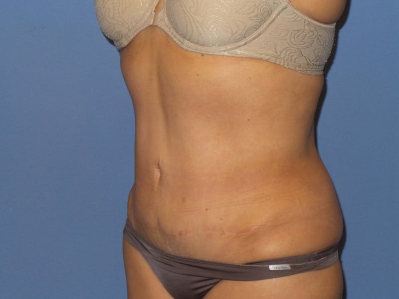 BodyTite™ Before and After Before & After Gallery - Patient 115258 - Image 2