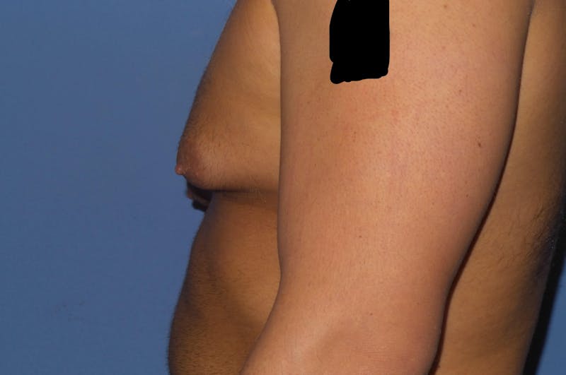 Gynecomastia (Male Breast Reduction) Before & After Gallery - Patient 307008 - Image 3