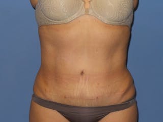 BodyTite™ Before and After Before & After Gallery - Patient 115258 - Image 4