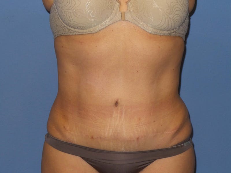 BodyTite™ Before and After Before & After Gallery - Patient 115258 - Image 4