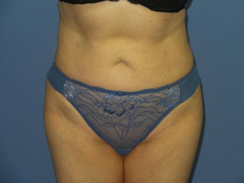 BodyTite™ Before and After Before & After Gallery - Patient 237245 - Image 2