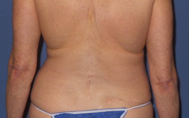 BodyTite™ Before and After Before & After Gallery - Patient 237245 - Image 5