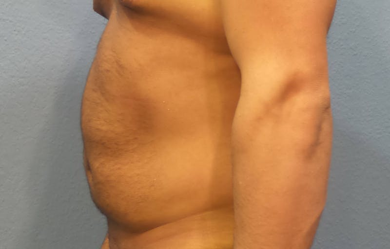 BodyTite™ Before and After Before & After Gallery - Patient 355589 - Image 3