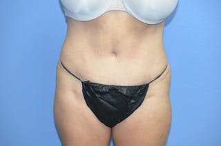 BodyTite™ Before and After Before & After Gallery - Patient 785652 - Image 2