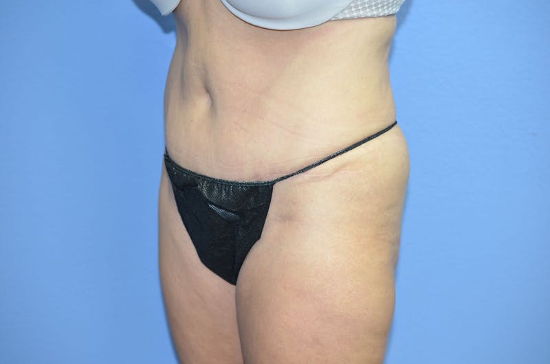 BodyTite™ Before and After Before & After Gallery - Patient 785652 - Image 4