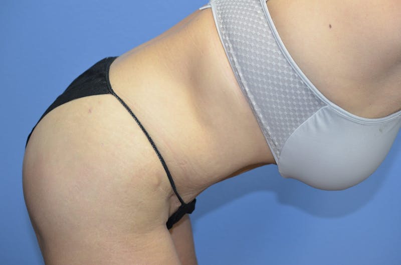 BodyTite™ Before and After Before & After Gallery - Patient 785652 - Image 8