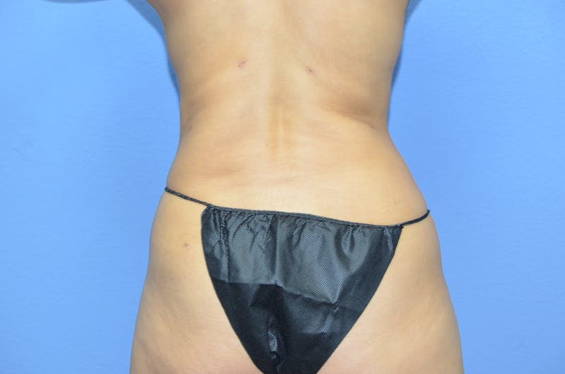 BodyTite™ Before and After Before & After Gallery - Patient 399770 - Image 4