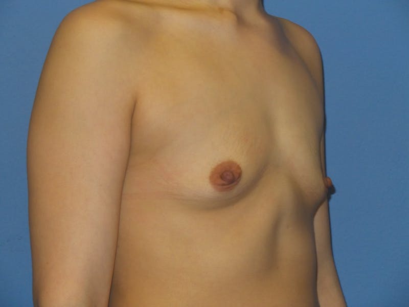 Breast Augmentation Before & After Gallery - Patient 220214 - Image 3