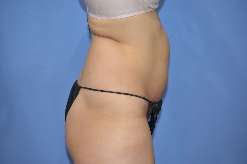 BodyTite™ Before and After Before & After Gallery - Patient 399770 - Image 9