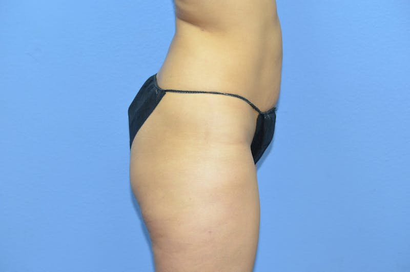 BodyTite™ Before and After Before & After Gallery - Patient 399770 - Image 10