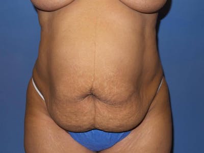 Tummy Tuck Before & After Gallery - Patient 217364 - Image 1