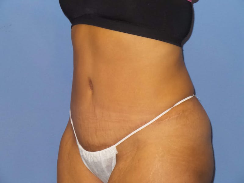 Tummy Tuck Before & After Gallery - Patient 217364 - Image 4