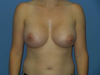Breast Augmentation Before & After Gallery - Patient 250528 - Image 2