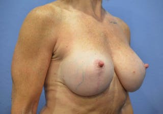 Breast Augmentation + Lift Before & After Gallery - Patient 376698 - Image 4