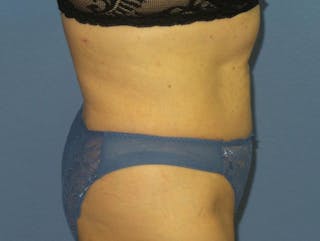 Liposuction Before & After Gallery - Patient 353808 - Image 4