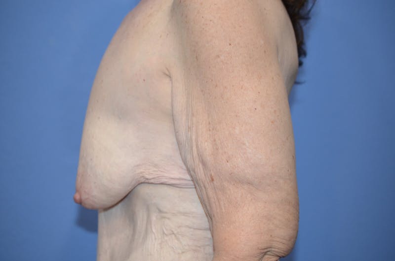 Breast Augmentation + Lift Before & After Gallery - Patient 381941 - Image 3