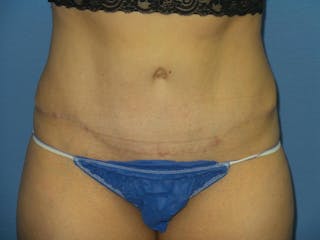 Tummy Tuck Before & After Gallery - Patient 344180 - Image 2
