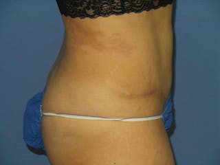 Tummy Tuck Before & After Gallery - Patient 344180 - Image 4