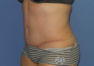Tummy Tuck Before & After Gallery - Patient 240292 - Image 4
