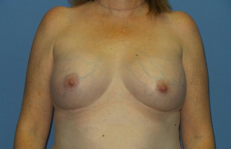 Breast Augmentation Before & After Gallery - Patient 193557 - Image 2