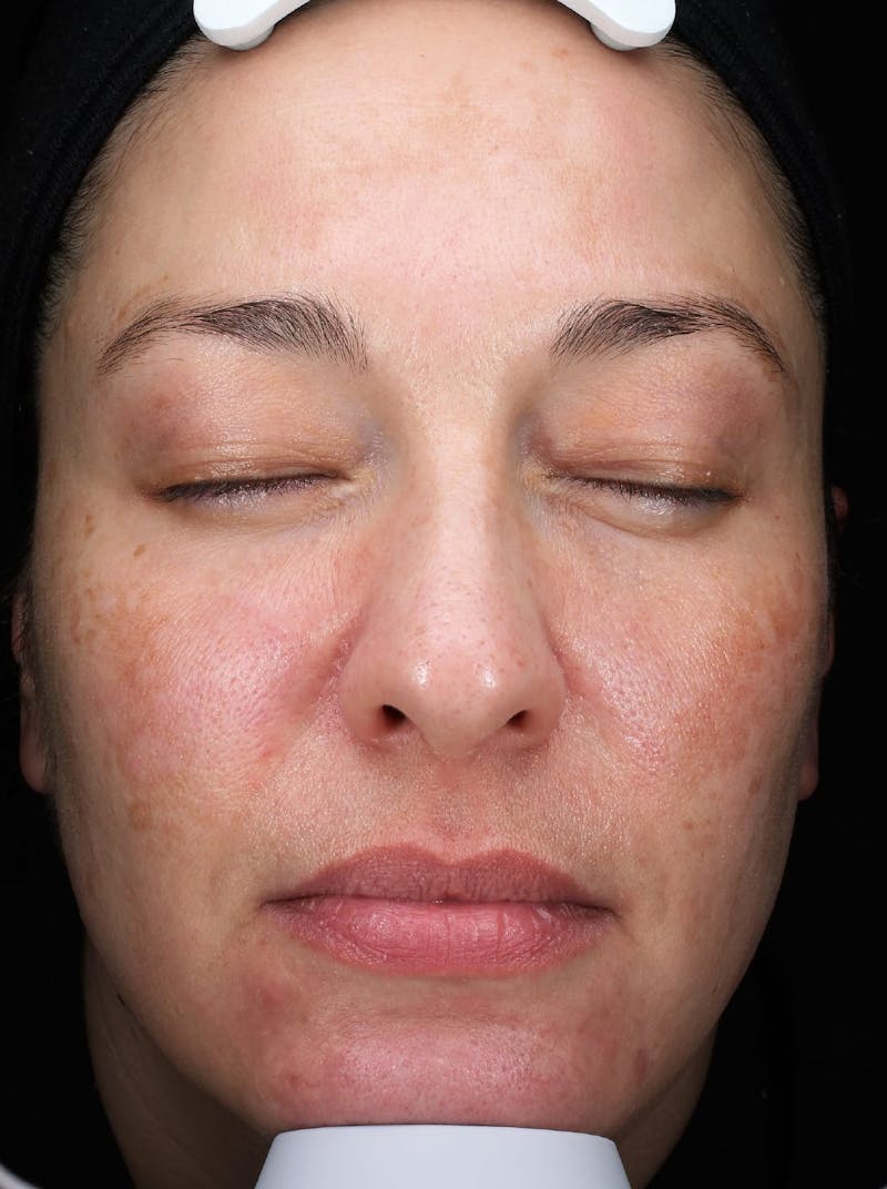 Clear + Brilliant® Before & After Gallery - Patient 200277 - Image 2