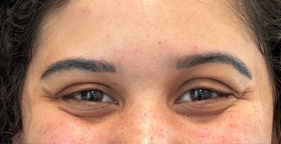 Jeuveau® Before & After Gallery - Patient 183579 - Image 1