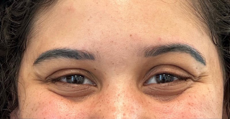 Jeuveau® Before & After Gallery - Patient 183579 - Image 1