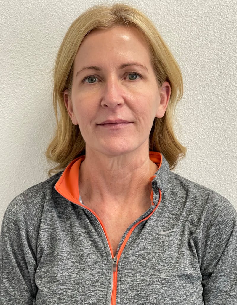 Morpheus8® Before & After Gallery - Patient 181468 - Image 2