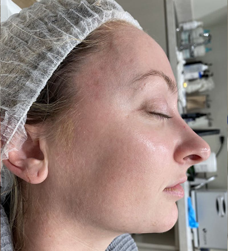 Sciton® BBL Hero Before & After Gallery - Patient 391884 - Image 2