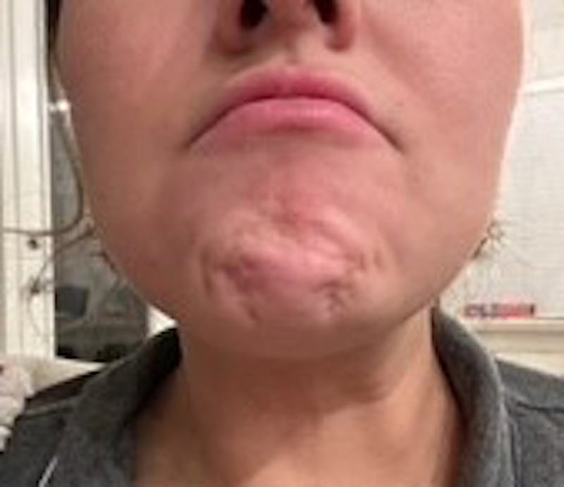 BOTOX Before & After Gallery - Patient 189608 - Image 3