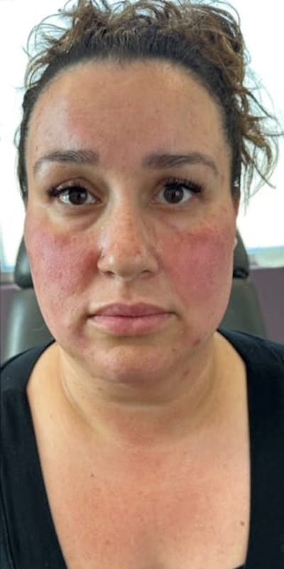 Jawline Filler Before & After Gallery - Patient 193308 - Image 2