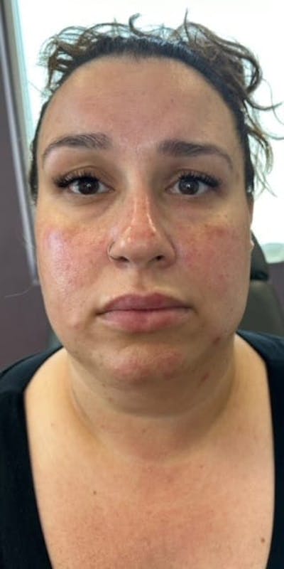 Jawline Filler Before & After Gallery - Patient 193308 - Image 1