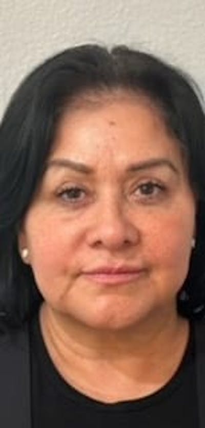 Cheek Filler Before & After Gallery - Patient 346279 - Image 2