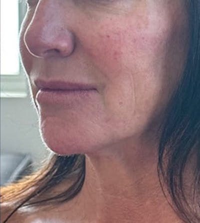 Chin Filler Before & After Gallery - Patient 116588 - Image 2
