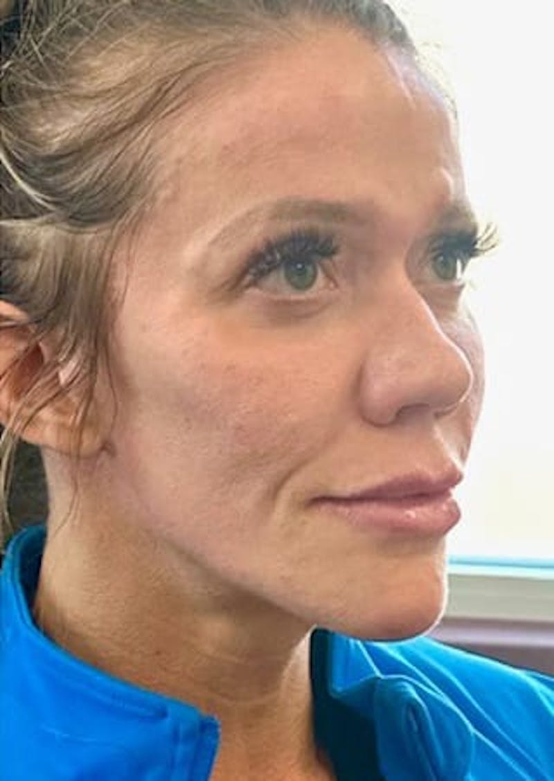 Cheek Filler Before & After Gallery - Patient 393433 - Image 2