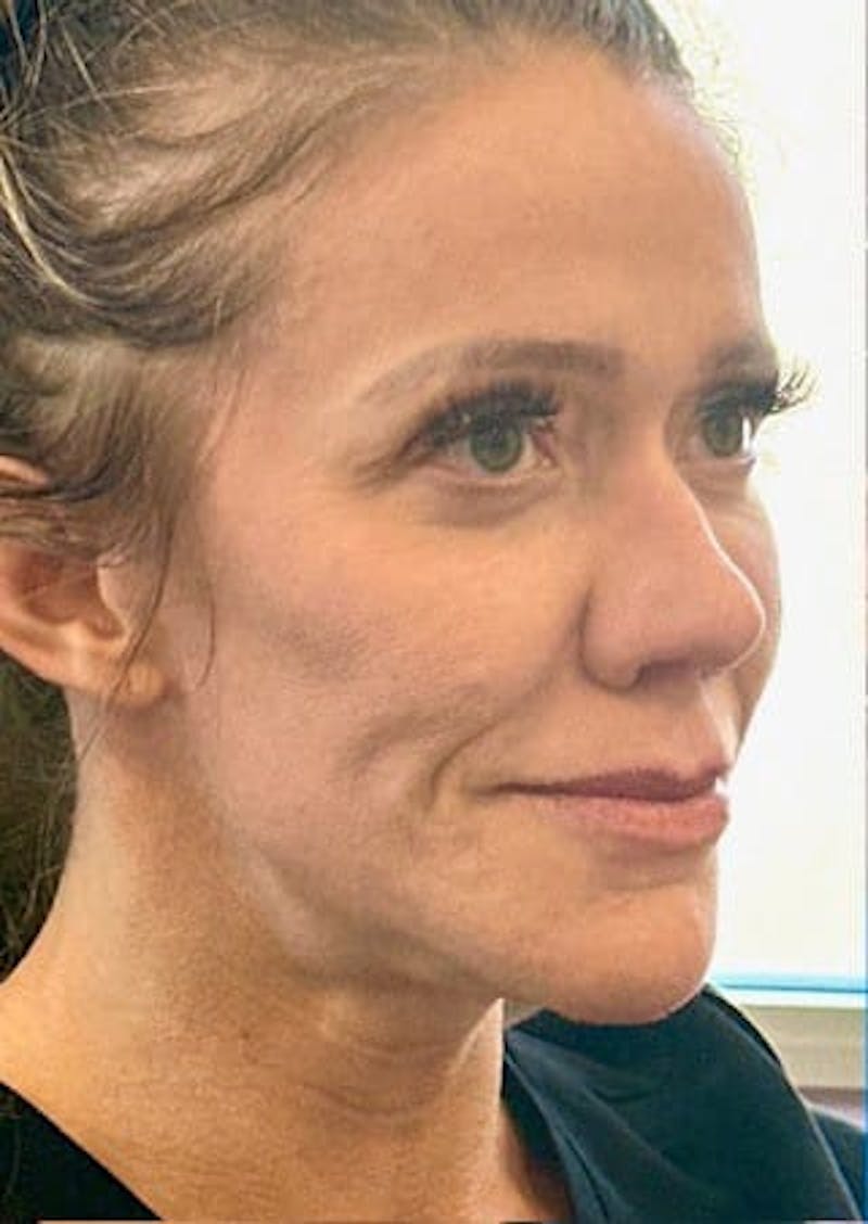 Cheek Filler Before & After Gallery - Patient 393433 - Image 1