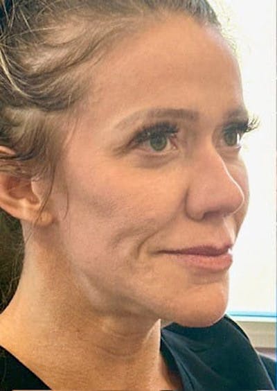 Cheek Filler Before & After Gallery - Patient 393433 - Image 1