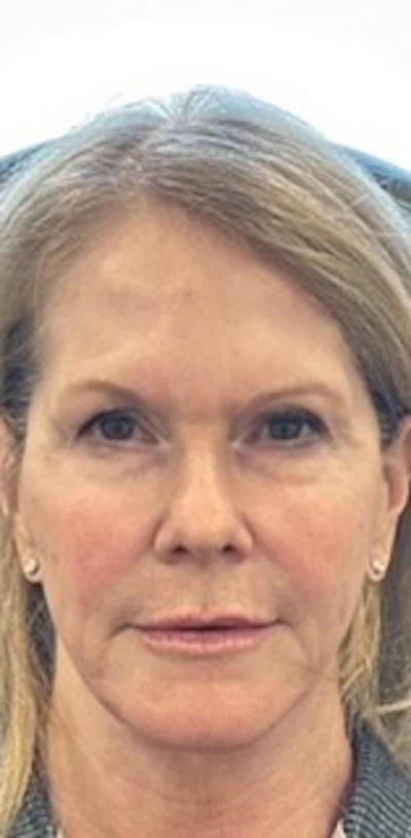 Chin Filler Before & After Gallery - Patient 217705 - Image 2